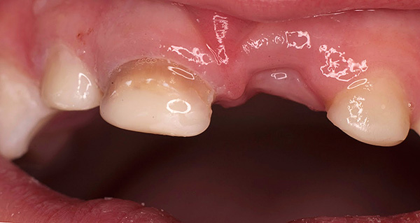 A perda precoce de dentes decíduos geralmente leva à má oclusão, à medida que os dentes adjacentes começam a mudar para um espaço vazio na fila.