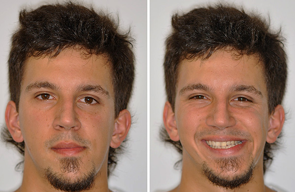 Anomalias da oclusão são frequentemente associadas a alguma assimetria da face.