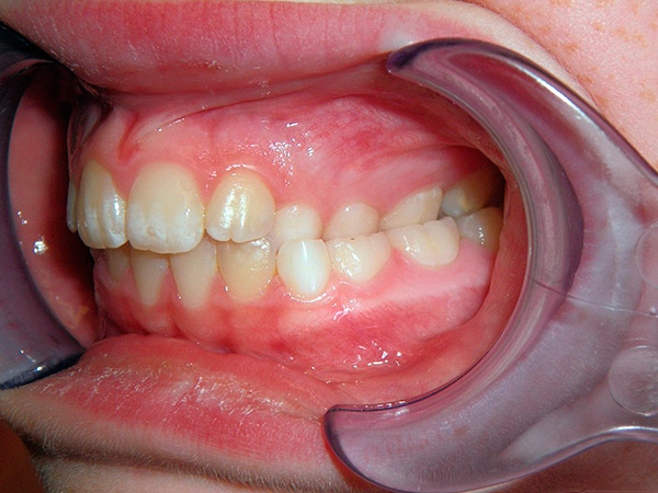 Às vezes as dentições se cruzam apenas na região lateral ...