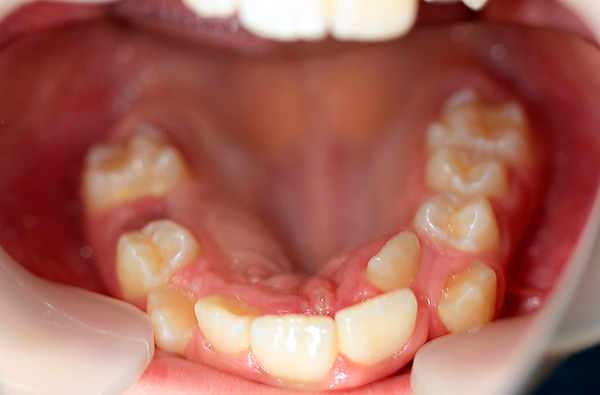 A violação do tempo e da sequência da dentição também pode afetar a mordida, não para melhor.