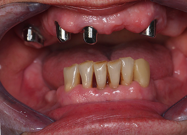Situazione clinica prima delle protesi: le corone metalliche sono installate sui denti conservati della mascella superiore.