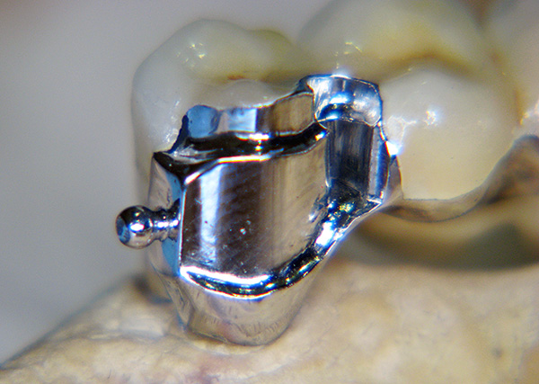Parte della serratura si trova sulla corona montata sul dente.