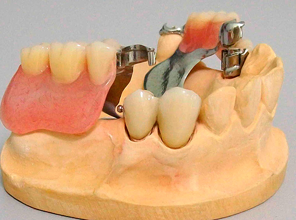A differenza dei fermagli, gli accessori sono più perfetti in termini di estetica e affidabilità dell'attacco.