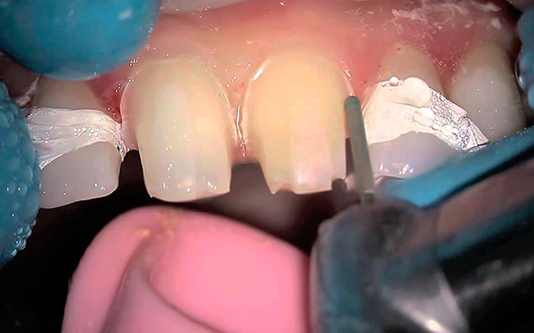 Uno svantaggio significativo della protesi di chiusura sulle serrature è la necessità di ruotare i denti di supporto sotto le corone.