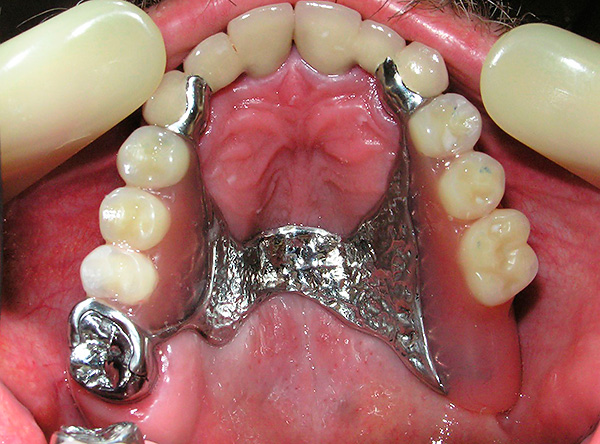 In alcuni casi clinici, le protesi ad arco possono essere un'ottima opzione per ripristinare l'estetica e la funzione masticatoria.