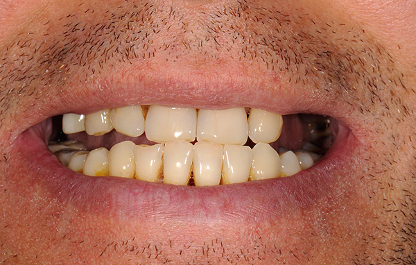 Difetti multipli nella dentatura (in particolare difetti dell'estremità) sono una delle indicazioni per l'installazione di una protesi di chiusura.