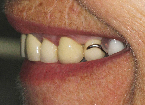 Sfortunatamente, in alcuni casi, le chiusure della protesi di chiusura sono visibili con un sorriso.