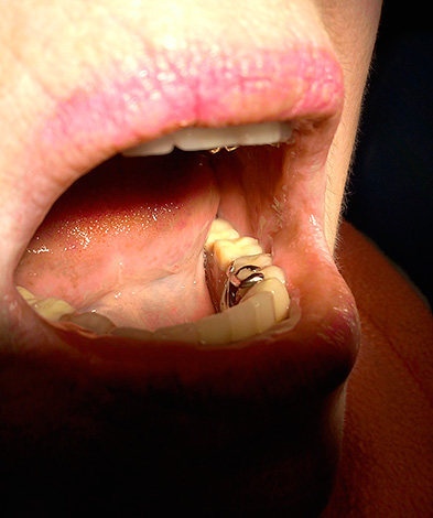 La situazione con la dentiera inferiore è simile ...