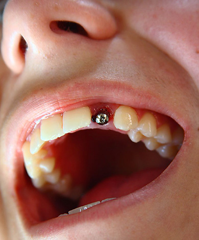 A foto mostra um exemplo da instalação de um implante Alpha BIO em uma área esteticamente significativa com a perda de um dente.