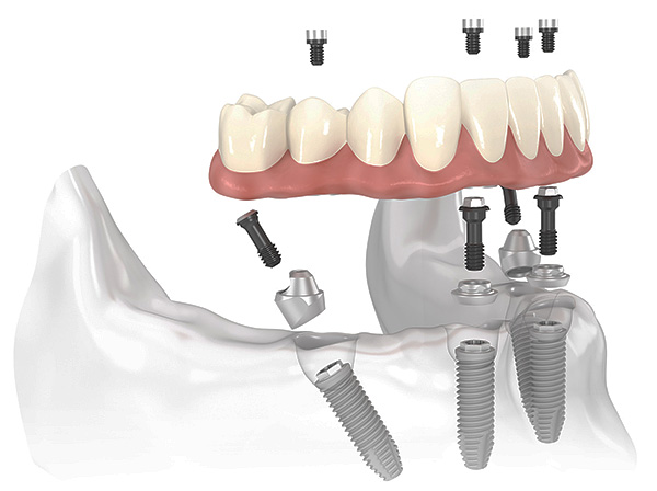 Esquema de implementação de próteses dentárias All-on-4.