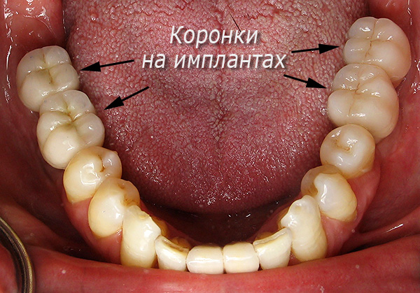 Próteses de mastigação de dentes em implantes Alpha BIO