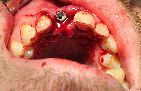 Os implantes Alpha BIO são feitos de titânio puro, não podem ser arrancados pelo corpo por um período de tempo ...