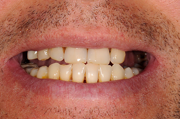 A fotografia mostra a condição dos dentes do paciente antes do tratamento com próteses em implantes.
