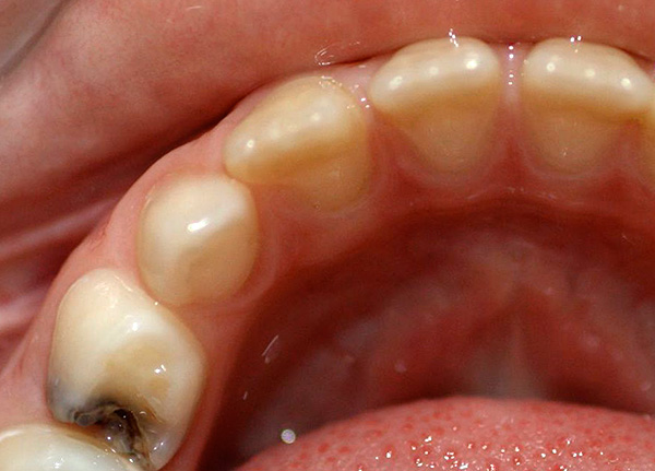 In caso di dolore acuto al dente, si consiglia di cercare immediatamente cure dentistiche di emergenza.