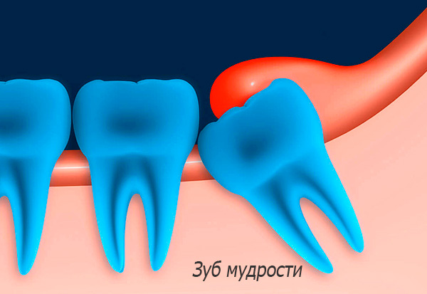 L'immagine mostra schematicamente un dente del giudizio in eruzione difficile.