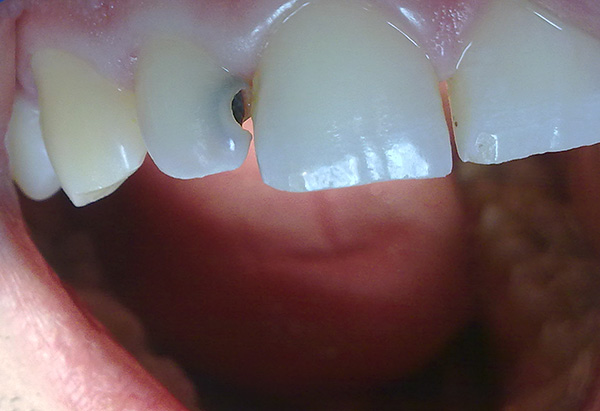 La cosa principale è non usare antidolorifici come alternativa alla visita dal dentista.