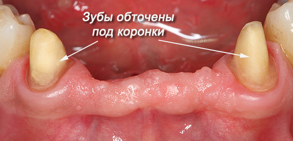 Os dentes selecionados sob o suporte da prótese geralmente moem sob as coroas.