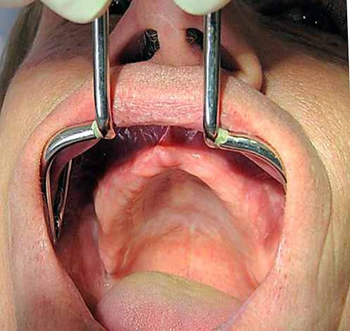 Infelizmente, na Rússia, a fabricação de uma prótese plástica acrílica é frequentemente solicitada quando todos os dentes (ou a maioria) já estão perdidos.