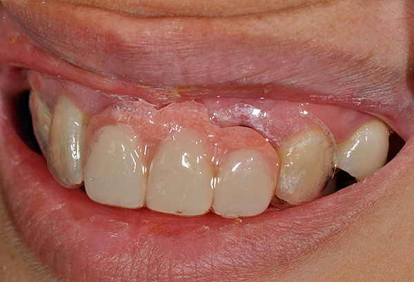 Enquanto isso, uma prótese de borboleta pode reduzir significativamente o desconforto (inclusive psicológico) associado à perda inesperada de dente.