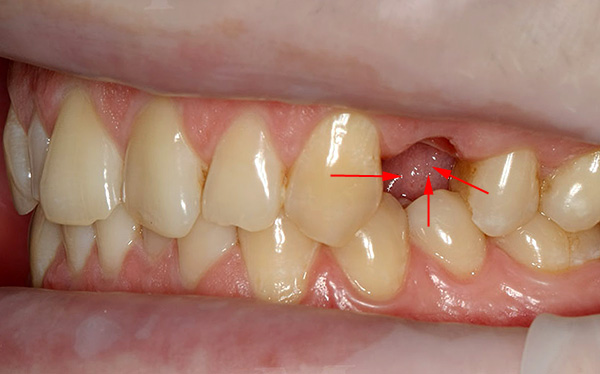 Na foto, as setas mostram a direção do deslocamento dentário quando um espaço vazio aparece em sua linha.