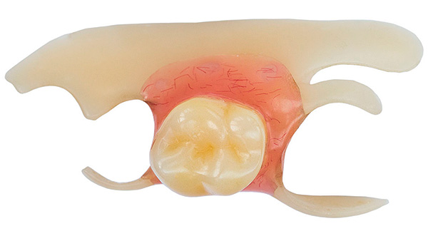 Como mostra a prática, mesmo a prótese borboleta mais simples e barata pode salvar o paciente de problemas muito desagradáveis ​​que às vezes surgem após a extração dentária.