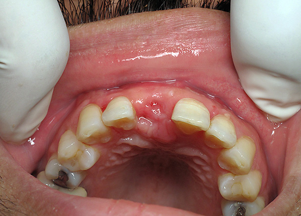 É altamente indesejável ficar sem próteses de dentes extraídos por um longo tempo.