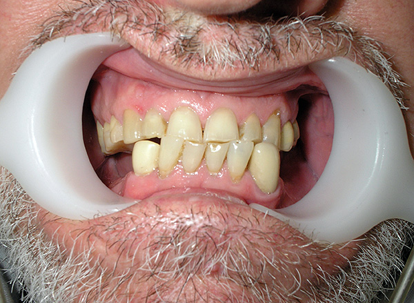 Quanto mais rápidas as próteses dos dentes perdidos são realizadas, menor o risco de consequências indesejáveis ​​para toda a dentição.