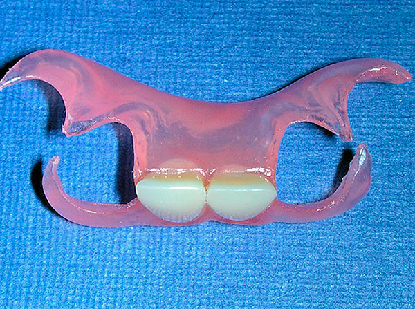 A foto mostra uma prótese borboleta para próteses de dois dentes da frente.