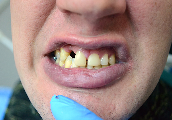 É assim que os dentes do paciente eram antes de usar uma prótese borboleta ...