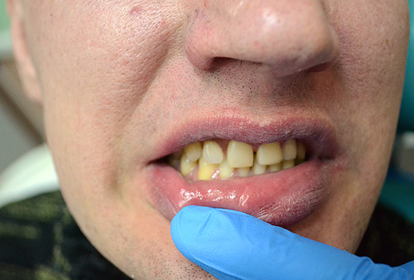 A prótese borboleta restaurou a estética da dentição.