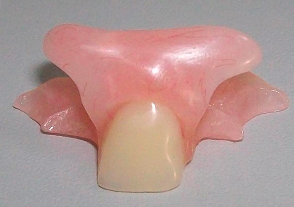 Prótese borboleta para próteses do dente da frente (incisivo)