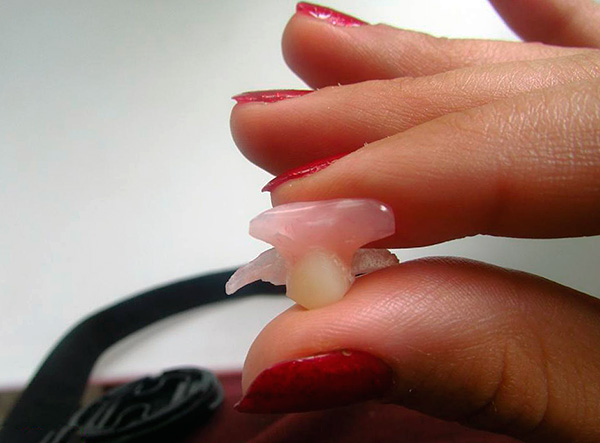 Uma prótese borboleta de alta qualidade, na maioria dos casos, é realizada com segurança nos dentes do pilar.