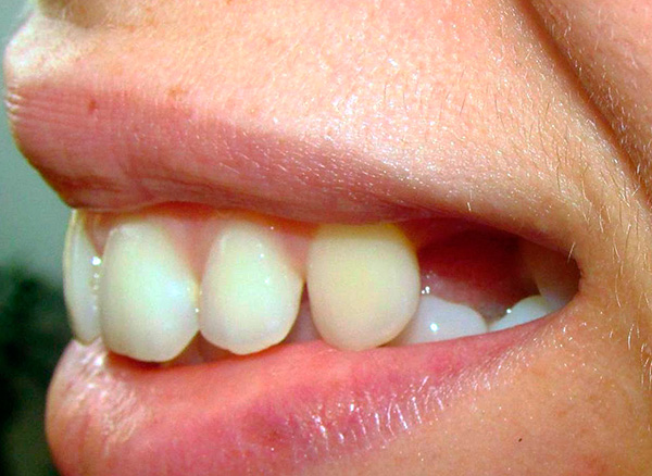 Foto antes das próteses de um dente removido ...