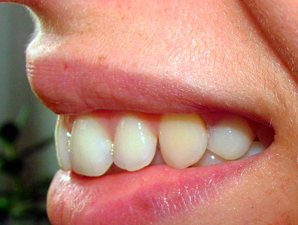 E esta fotografia mostra a condição dos dentes após o uso da prótese borboleta.