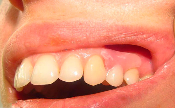 O dente restaurado pela prótese é praticamente indistinguível dos dentes nativos do paciente.