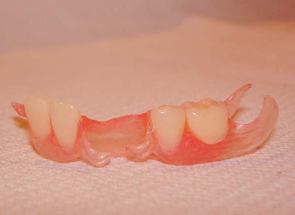 Com um grande número de dentes protéticos, as próteses sobre implantes em uma borboleta não são mais muito parecidas ...