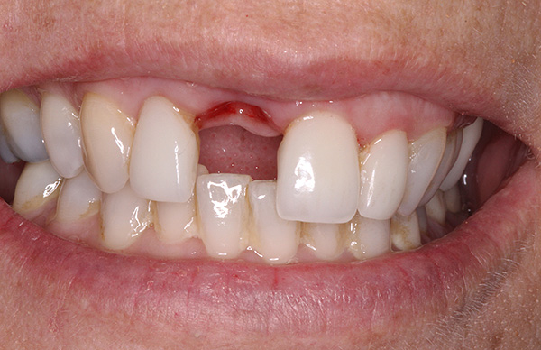 A perda de dentes da frente é especialmente desagradável para a maioria das pessoas, e uma prótese de borboleta nesse caso seria muito bem-vinda.