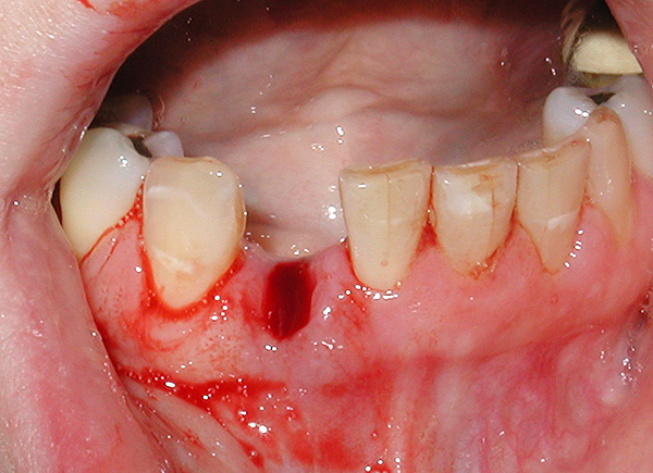 Ao usar a prótese de implante, não é necessário caminhar por várias semanas com um orifício na dentição.