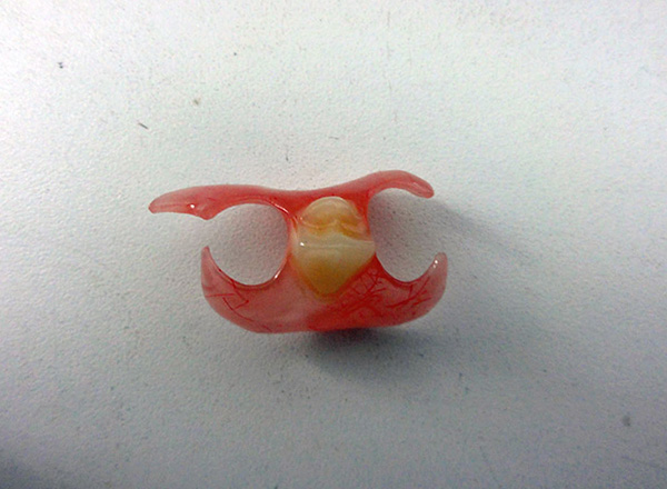Para uma fixação confiável da prótese borboleta, são necessários dois dentes do pilar (em casos raros, um é suficiente).