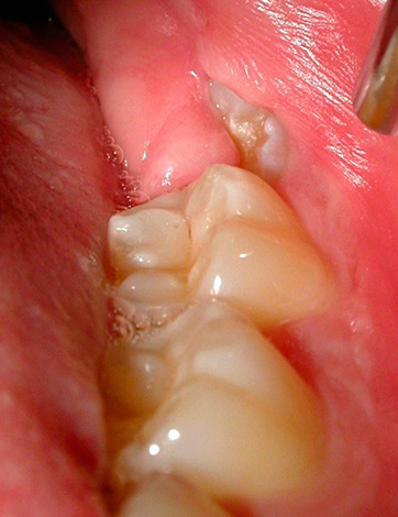 Dente del giudizio semi-dente