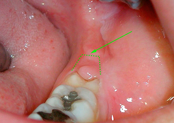 I denti del giudizio semi-rinforzati non vengono sempre rimossi, spesso limitati solo all'asportazione del cappuccio gengivale.
