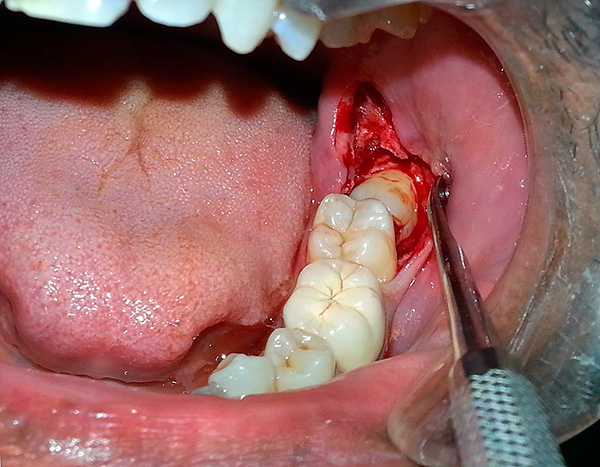 La foto mostra la rimozione dell'ottavo dente inferiore posizionato orizzontalmente nella mascella.