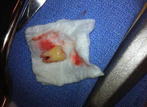In alcuni casi, possono verificarsi complicazioni dopo l'estrazione dei denti ritentati ed è utile sapere in anticipo cosa deve essere fatto in una determinata situazione ...