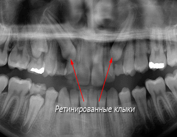 In questa radiografia, le zanne retinate sono chiaramente visibili.
