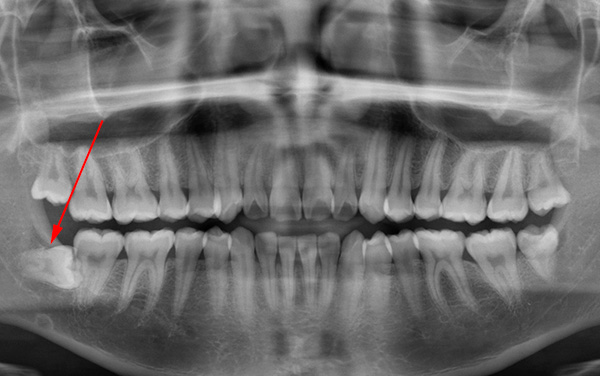 Con la posizione orizzontale del dente del giudizio nella mascella, poggia contro i sette, per cui non può tagliare.