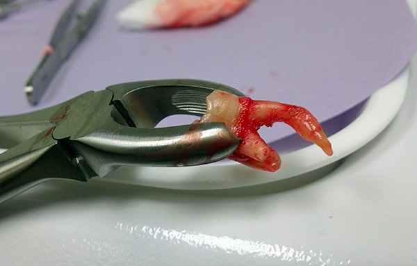 Un dente ritardato non viene sempre rimosso, anche se in alcuni casi è davvero necessario.