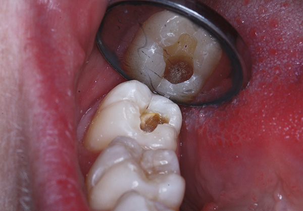 A volte sembra ai pazienti che il medico stia perforando indebitamente un dente, come se stesse ricevendo piacere da questo processo ...