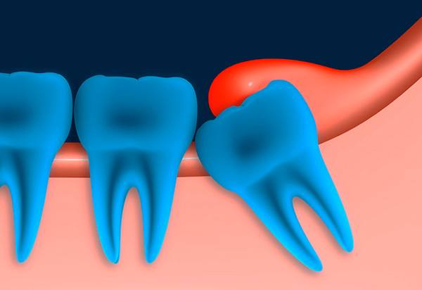 Spesso, un cappuccio gengivale si forma sopra un dente del giudizio parzialmente scoppiato - la sua infiammazione può creare i presupposti per rimuovere la figura otto.