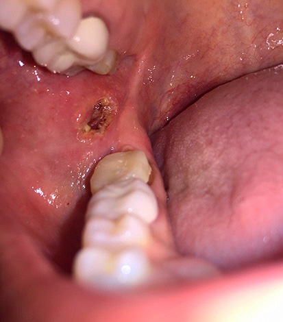 A volte i denti del giudizio portano a lesioni croniche alla guancia o alla gomma, che possono essere pericolose a causa del rischio di sviluppare tumori maligni.
