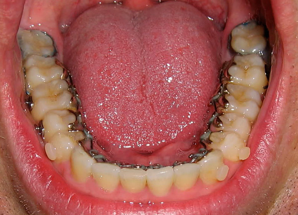 Quando si installano le parentesi graffe, non è sempre necessario rimuovere i denti del giudizio.